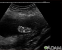 Ultrasound, normal fetus - foot