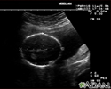 Ultrasound, normal fetus - head measurements