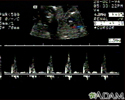 Ultrasound, ventricular septal defect - heartbeat