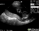 Ultrasound, normal relaxed placenta