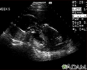 Ultrasound, normal fetus - profile view