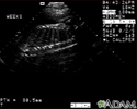 Ultrasound, normal fetus - spine and ribs