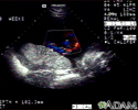 Ultrasound, color - normal umbilical cord