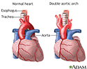 Double aortic arch