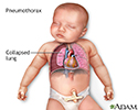 Pneumothorax