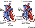 Tricuspid atresia
