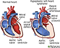 Hypoplastic left heart syndrome