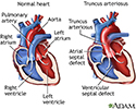 Truncus arteriosus