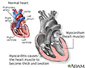 Myocarditis