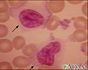 Mononucleosis - photomicrograph of cell