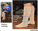 Pressure stockings