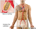 Coronary artery stent