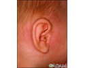 Mastoiditis - side view of head