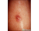Keratoacanthoma