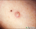 Keratoacanthoma