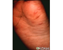 Hand, foot, and mouth disease on the foot