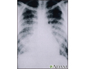 Chickenpox, acute pneumonia - chest X-ray