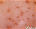 Chickenpox - close-up