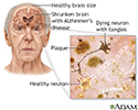 Alzheimer disease