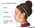 Infectious mononucleosis