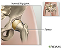 Hip joint replacement - Series