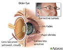 Aged eye anatomy