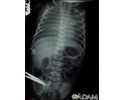 Totally anomalous pulmonary venous return - X-ray