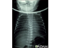 Totally anomalous pulmonary venous return - X-ray