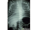 Totally anomalous pulmonary venous return - X-ray