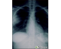 Aspergillosis - chest X-ray
