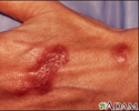 Mycobacterium marinum infection on the hand