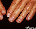 Half and half nails