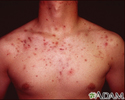 Acne - cystic on the chest