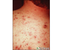 Acne - vulgaris on the back