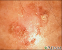 Actinic keratosis - close-up