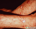 Actinic keratosis on the forearms