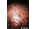 Actinic keratosis on the scalp