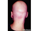 Alopecia totalis - back view of the head