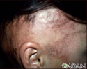 Alopecia, under treatment