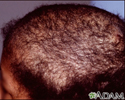 Trichotillomania - top of the head