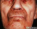 Amyloidosis of the face