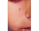 Tuberous sclerosis, angiofibromas  - face