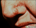 Skin cancer, basal cell carcinoma - nose