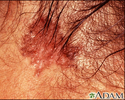 Skin cancer, basal cell carcinoma - pigmented