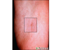 Basal cell nevus syndrome - plantar pits