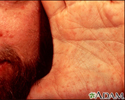 Basal cell nevus syndrome - face and hand