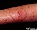 Cellulitis