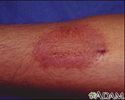 Dermatitis - contact