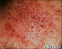 Dermatitis de contacto alérgica - vista de cerca