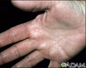 Hyperlinearity in atopic dermatitis - on the palm